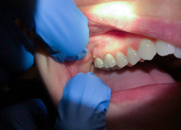 Best Emergency Treatment for Toothache in Leith Hatfield, PA